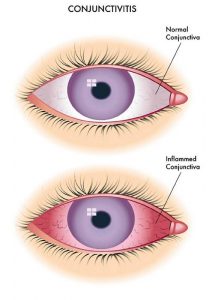 home remedies for pink eye diagram
