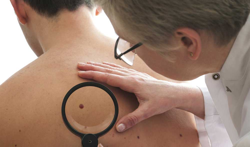 examining skin moles