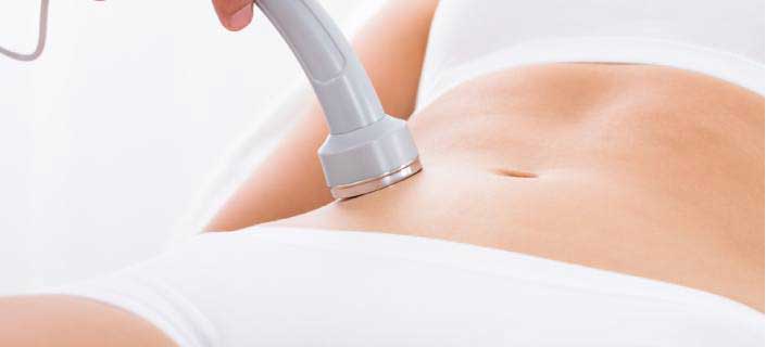 laser therapy for stretch marks